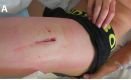 Result of open biopsy of thigh muscle Result of open biopsy of thigh muscle